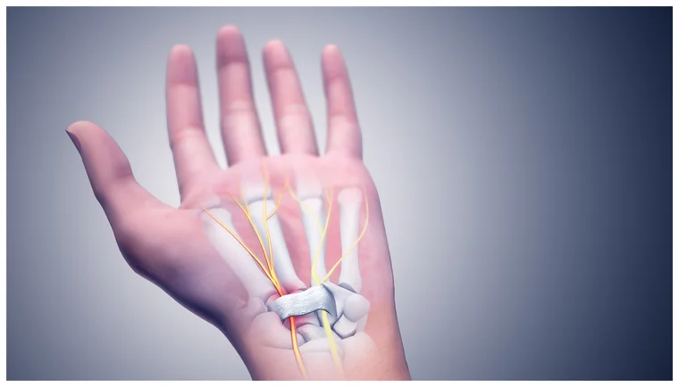 Carpal tunnel syndrome: the median nerve is compressed where it passes through the wrist, causing numbness and tingling in the thumb, index and middle fingers — classically worse at night.